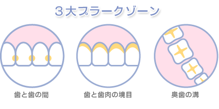 3大プラークゾーン